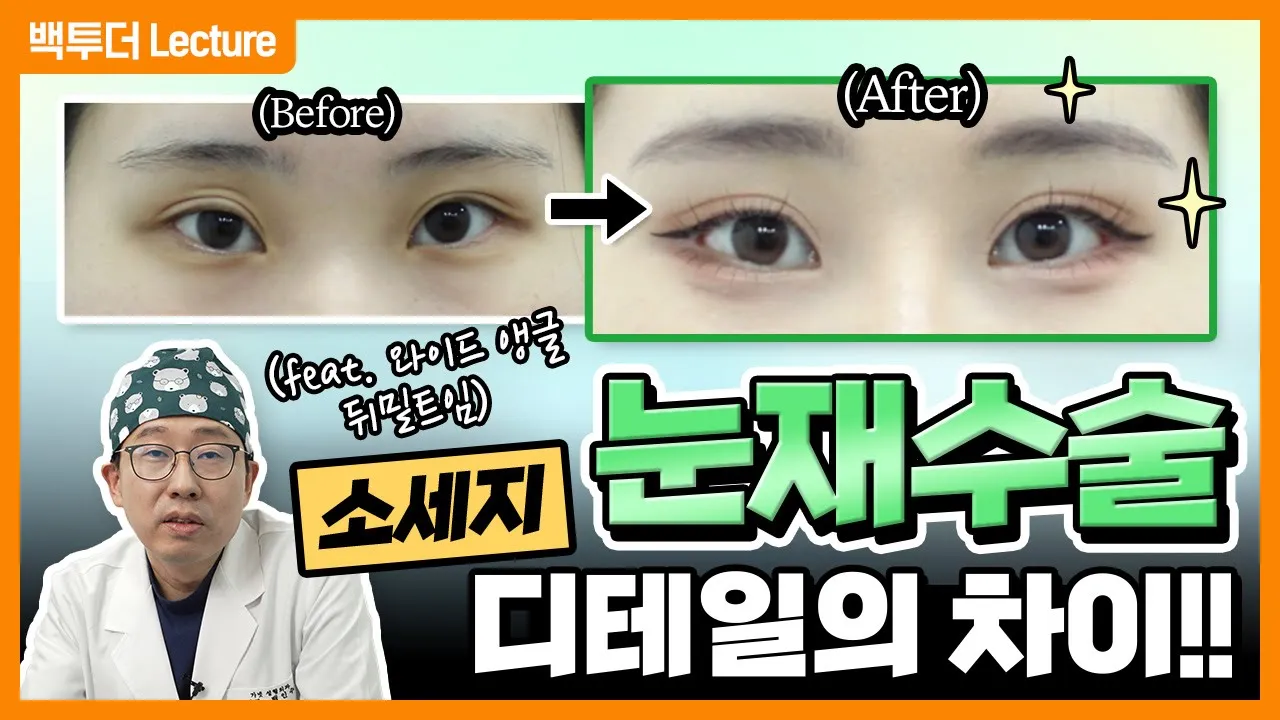 [눈재수술] 사나운 눈을 부드러운 눈으로 바꾸려면❓ 👀 (feat. 쌍꺼풀재수술·눈매교정·뒤트임·밑트임 전후)