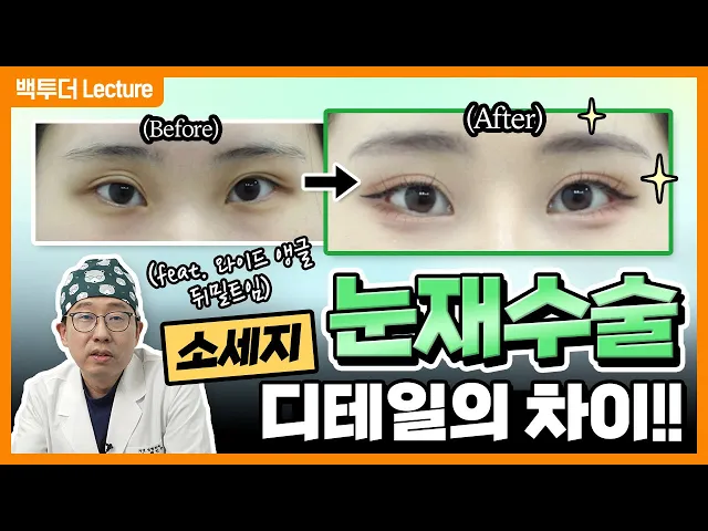 [눈재수술] 사나운 눈을 부드러운 눈으로 바꾸려면❓ 👀 (feat. 쌍꺼풀재수술·눈매교정·뒤트임·밑트임 전후)