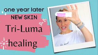 Retin A and Tri-Luma results after one year of treatment and healing my sun damage and melasma