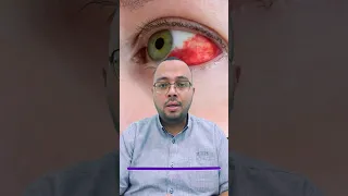 علاج النزيف الذي يحدث على بياض العين  العيون  العين  نزيف دندنها