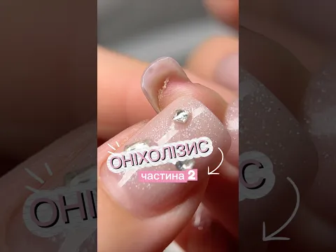 ОНІХОЛІЗИС: чим все закінчилось? 🙀 Чи можна покривати оніхолізис гель лаком? 🤔