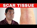 Download Lagu How To Break Up Painful Scar Tissue To Help Heal After A Knee Replacement