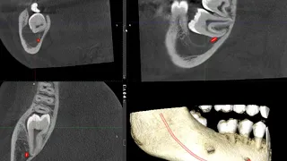 Dentigerous cyst