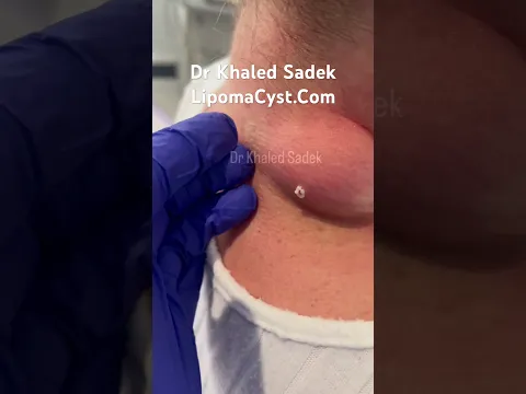 Milking the cyst on the daily #cystremoval #cystremoval dr Khaled sadek