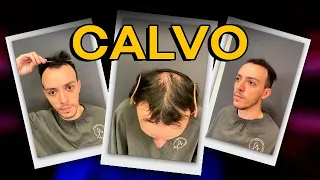 QUANDO EU FIQUEI CALVO