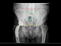 Hip Arthroplasty CPT code - simplify medical coding