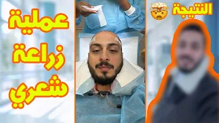 تفاصيل عملية زراعة شعر وليد | راح تنصدموا من النتيجة 🤯