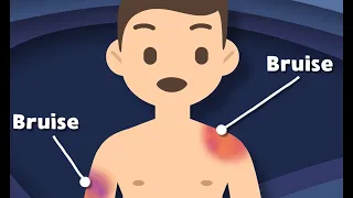 How Do Bruises Happen… And More Fun Anatomy Lessons!