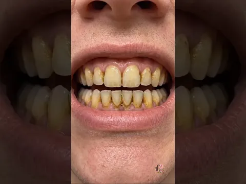 Get Instant Teeth Whitening, Happy Smile 😆 #teethwhitening #beauty #shorts
