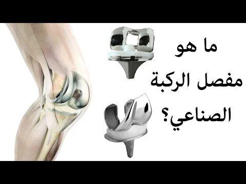 ما هو مفصل الركبة الصناعي
