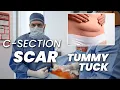 What Happens to Your C-Section Scar During a Tummy Tuck