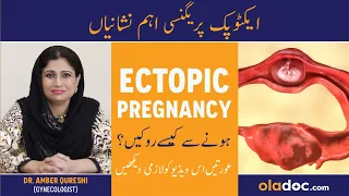 Download Ectopic Pregnancy Causes And Treatment - Ectopic Pregnancy Kya Hoti Hai -   Tube Men Hamal Ki Alamat MP3