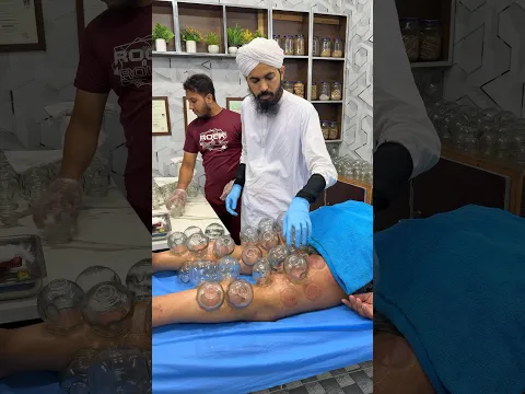 🔥 Tight & Painful Leg Muscles? Try Chinese Fire Cupping Massage Therapy | Dr Usman Faiz