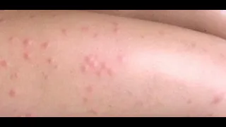 ظهور حبوب حمراء في الجسم مع حكة 