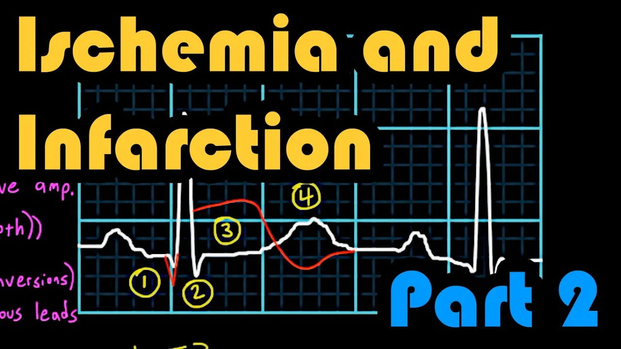 Ischemia, Infarction, and the Waveforms Q through U, Part 2: How to Read an EKG Curriculum