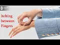 Itching between fingers Finger Webspace Area Cause Cure - Dr Rashmi Ravindra Doctors Circle