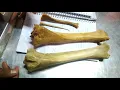 Lagu 3 Tibia \u0026 Fibula Bone