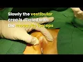 Download Lagu What is a Hymen and How Does It break | Dr. Ashutosh Shah | Elegance Clinic - Surat