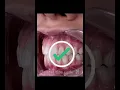 Time lapse of braces Transformation from crooked teeth to aligned