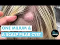 A Milium A Pilar Cyst Derm Days w Dr Pimple Popper