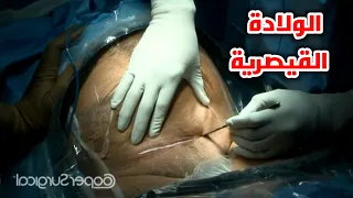 شاهد عملية الولادة القيصرية وقل سبحان الله الخالق Cesarean Section Surgical Technique HD Video 