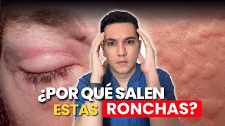 ¿Te salen ronchas en la piel? Esto lo podría estar causando