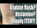 Oxalate Dumping Skin Rash Histamine Connections Between Oxalate Histamine Mold Pyroluria