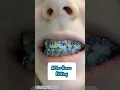 Before and After Brace Fitting Appointment