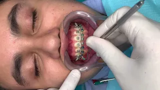 🔥Mantenimiento de los Frenillos Metálicos de Ortodoncia🔥