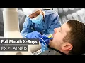 Dental X-Ray Full Mouth Series FMX Explained