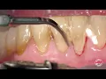 Download Lagu Gingivite \u0026 GBT - Guided Biofilm Therapy
