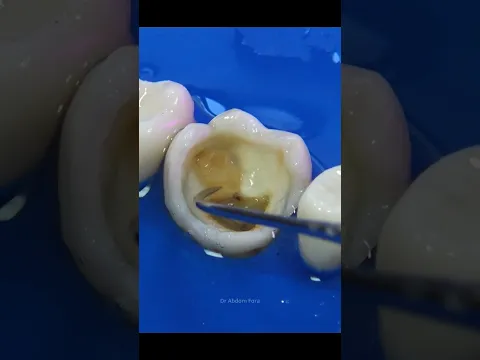 What is deroofing in endodontics?   #dentist