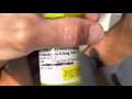 Teva Alprazolam - what happens after