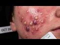 Loan Nguyen Acne Treatment 27zz