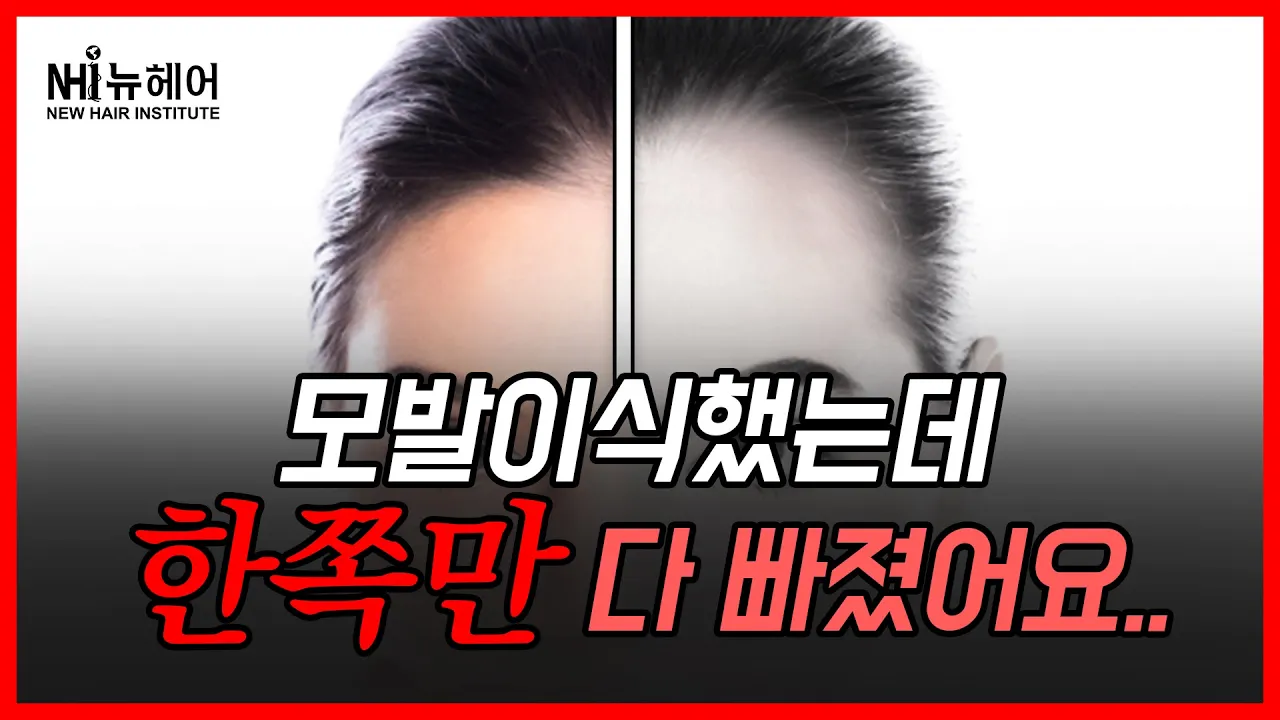 모발이식 암흑기...한쪽만 다 빠졌는데 괜찮을까?│뉴헤어