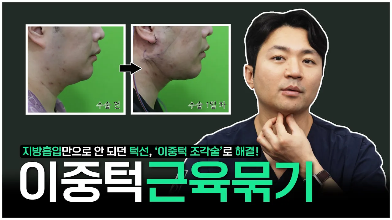 이중턱근육묶기, 근육만 묶으면 다야? [로이성형외과]