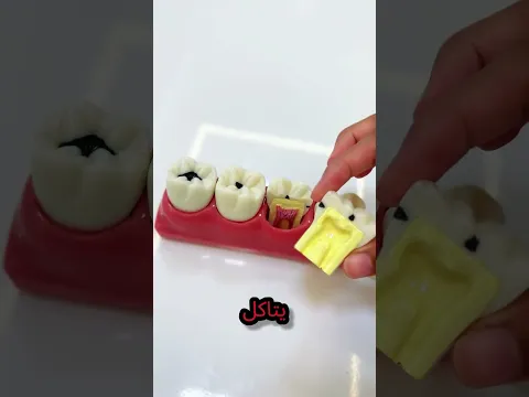 لهذا السبب.. لا تتجاهل النقطة السوداء في أسنانك! 😱 #قصص #اكسبلور #viral  #shorts