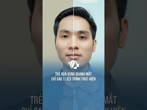 Trẻ hóa vùng da quanh mắt chỉ sau 1 liệu trình thực hiện