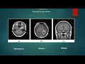 Brain Tumor Classification using ML and CV