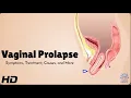 Vaginal Prolapse 101 What Every Woman Should Know