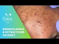 Light Dermaplaning Blackhead Extractions on Emily