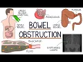 Understanding Bowel Obstruction