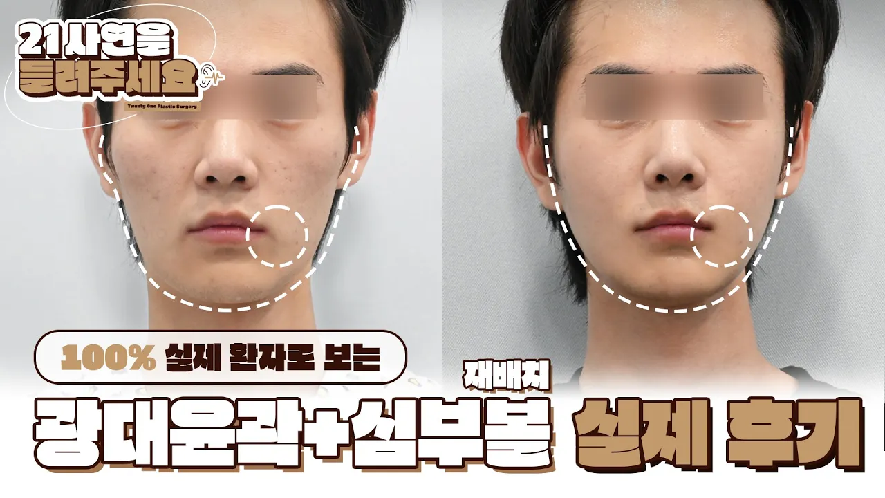 광대윤곽+심부볼재배치 실제 후기 | 21 사연을 들려주세요