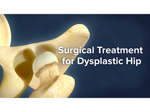 Surgical Treatment for Dysplastic Hip | Cincinnati Children's