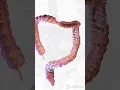 Download Lagu 💧 Understanding Diarrhea: Causes and Care 💧  #anatomy #meded #3danimation