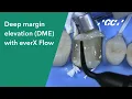 Deep margin elevation DME with everX Flow