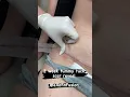 Download Lagu 2 week tummy tuck scar reveal