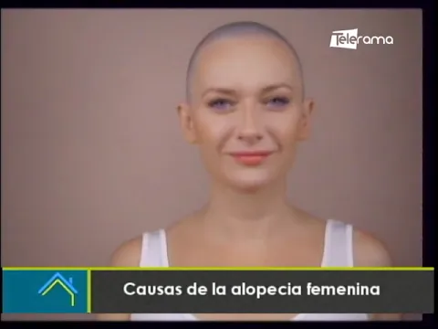 Causas de la alopecia femenina