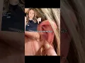 Do THIS to TREAT PREVENT ear blackheads