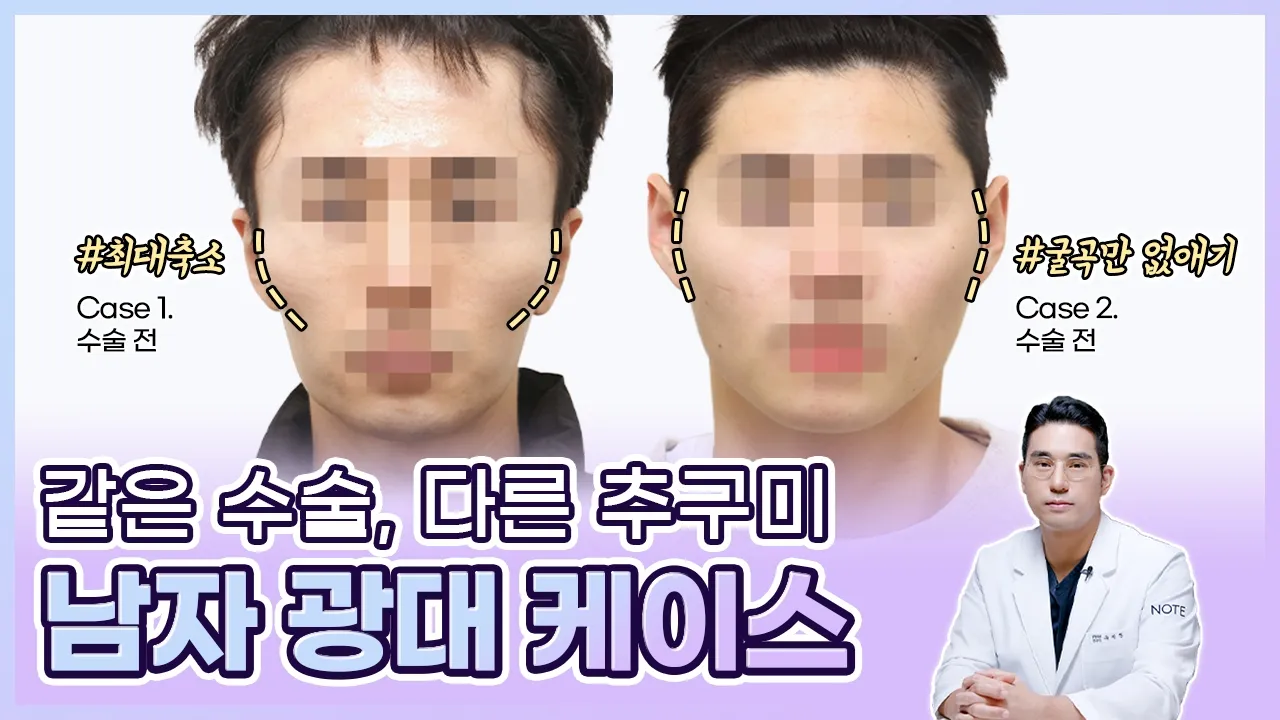 [유.케.리] 📍 CT로 보는 케이스 리뷰 l 광대 축소 l 남자 광대 l 자연 vs 화려 l 노트성형외과